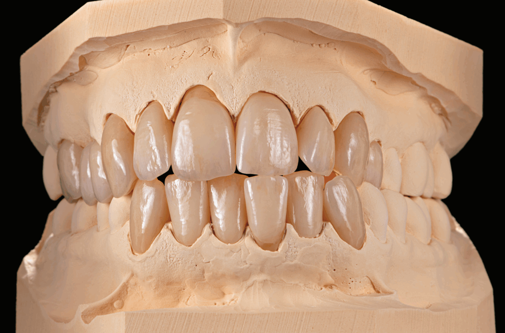 NexxZr®+ Multi 2.0 Multilayer Zirconia example
